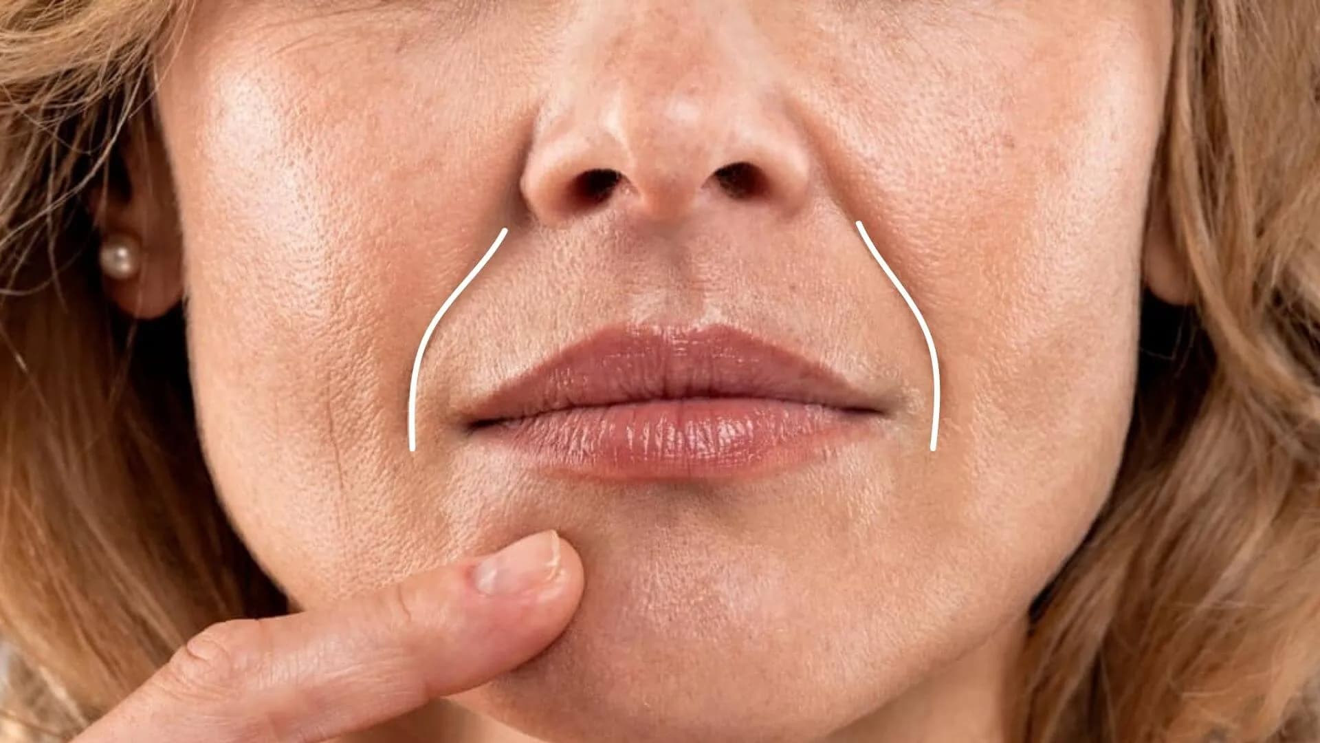 Filler i nasolabialfoldene behandling