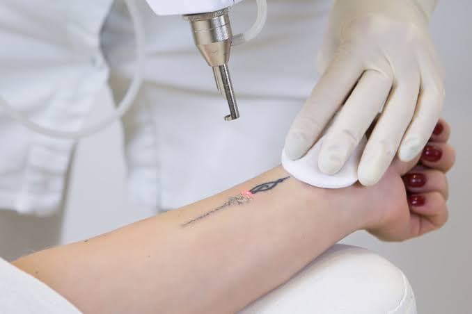 Tatoveringsfjerning bilde 3