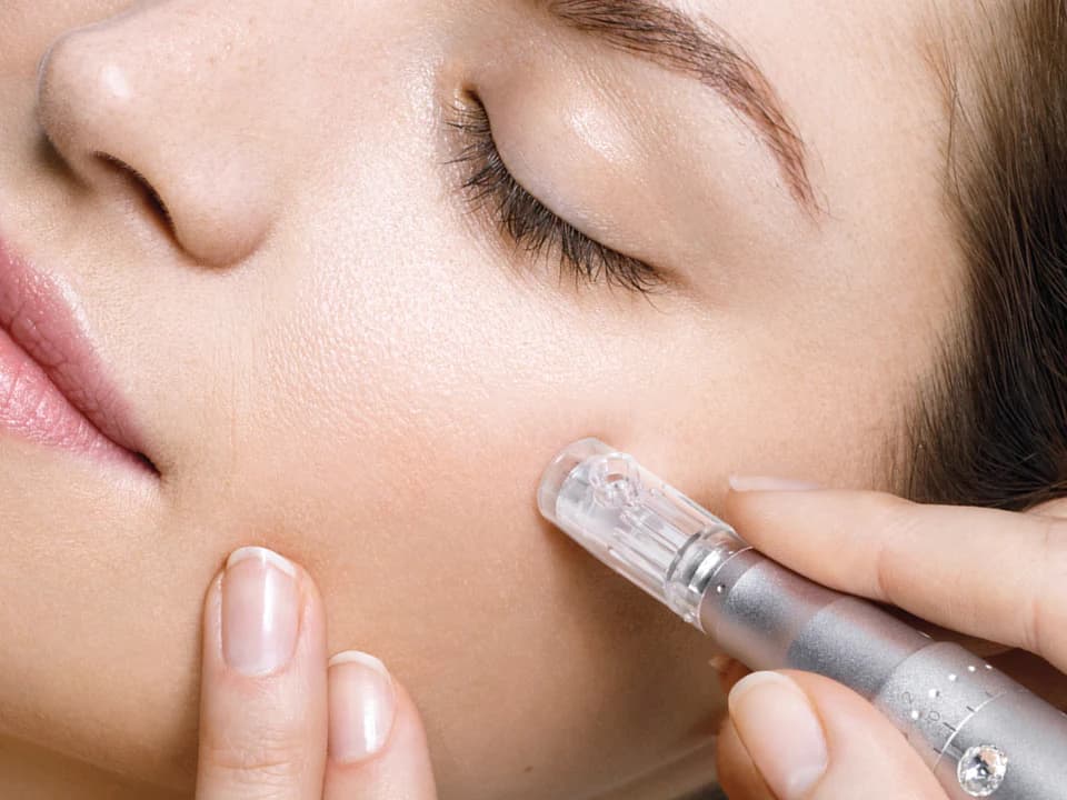 Microneedling behandling