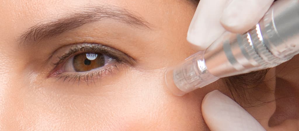 Microneedling bilde 1