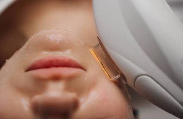 IPL / Fotofacial behandling