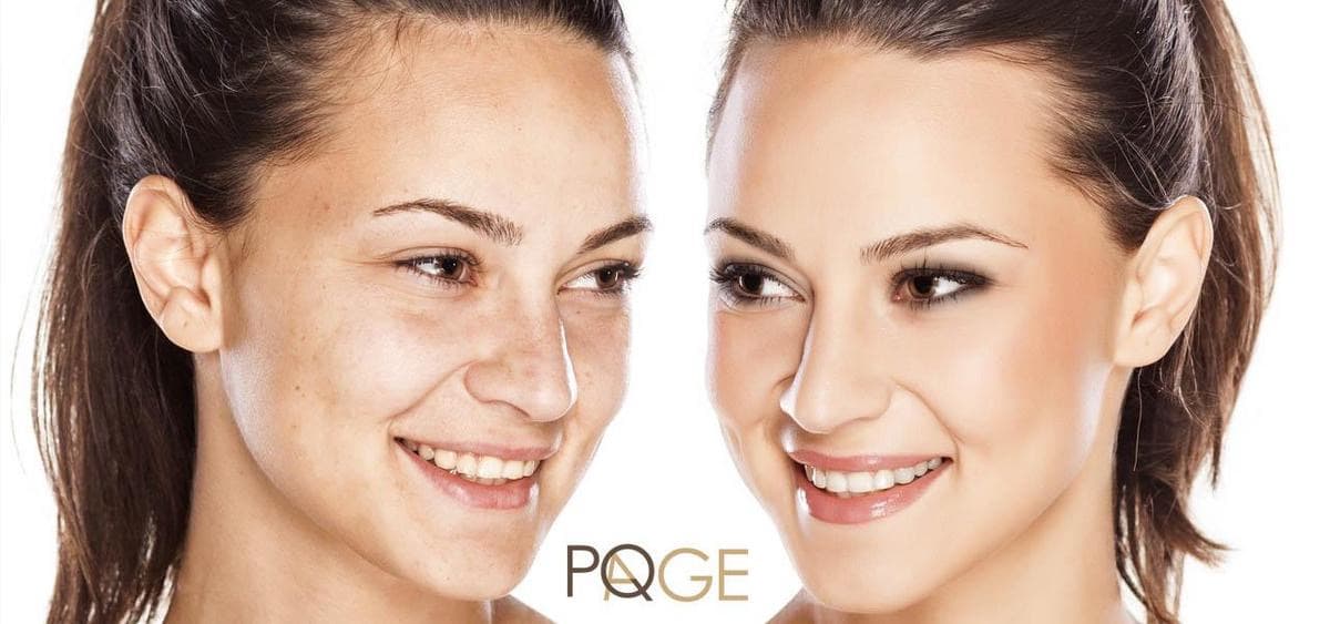 PQ Evolution Peeling behandling